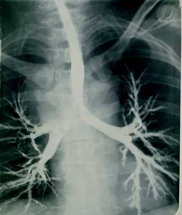 ТРАХЕЯ, видная в центре рентгенограммы, разделяется на два главных бронха, ведущих к правому и левому легкому и разветвляющихся на бронхиальное дерево.