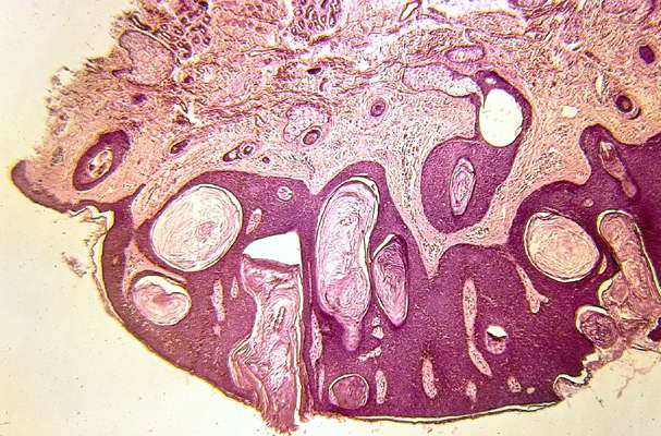 Опухолевые клетки под микроскопом.