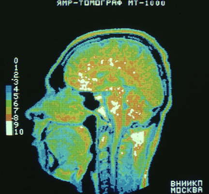 Компьютерный томограф. Томограмма головного мозга человека.