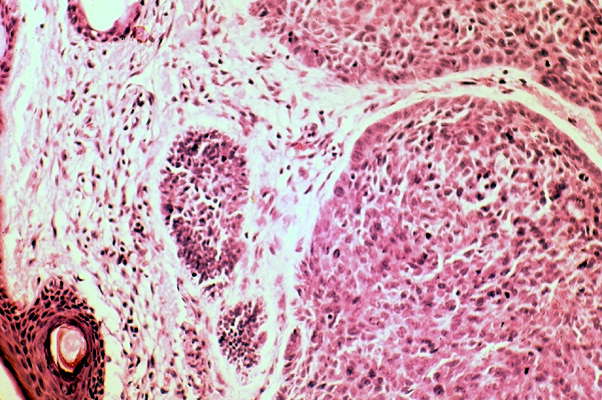 Раковая опухоль под микроскопом.
